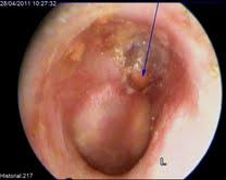 Tímpano Otitis I