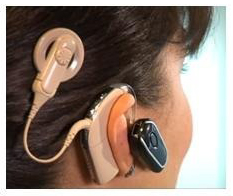 implante-coclear-nucleus-5