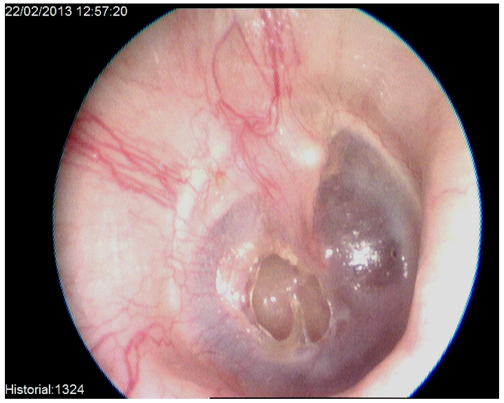 perforaci_n barotrauma