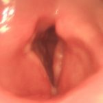Microcirugía endolaríngea Láser